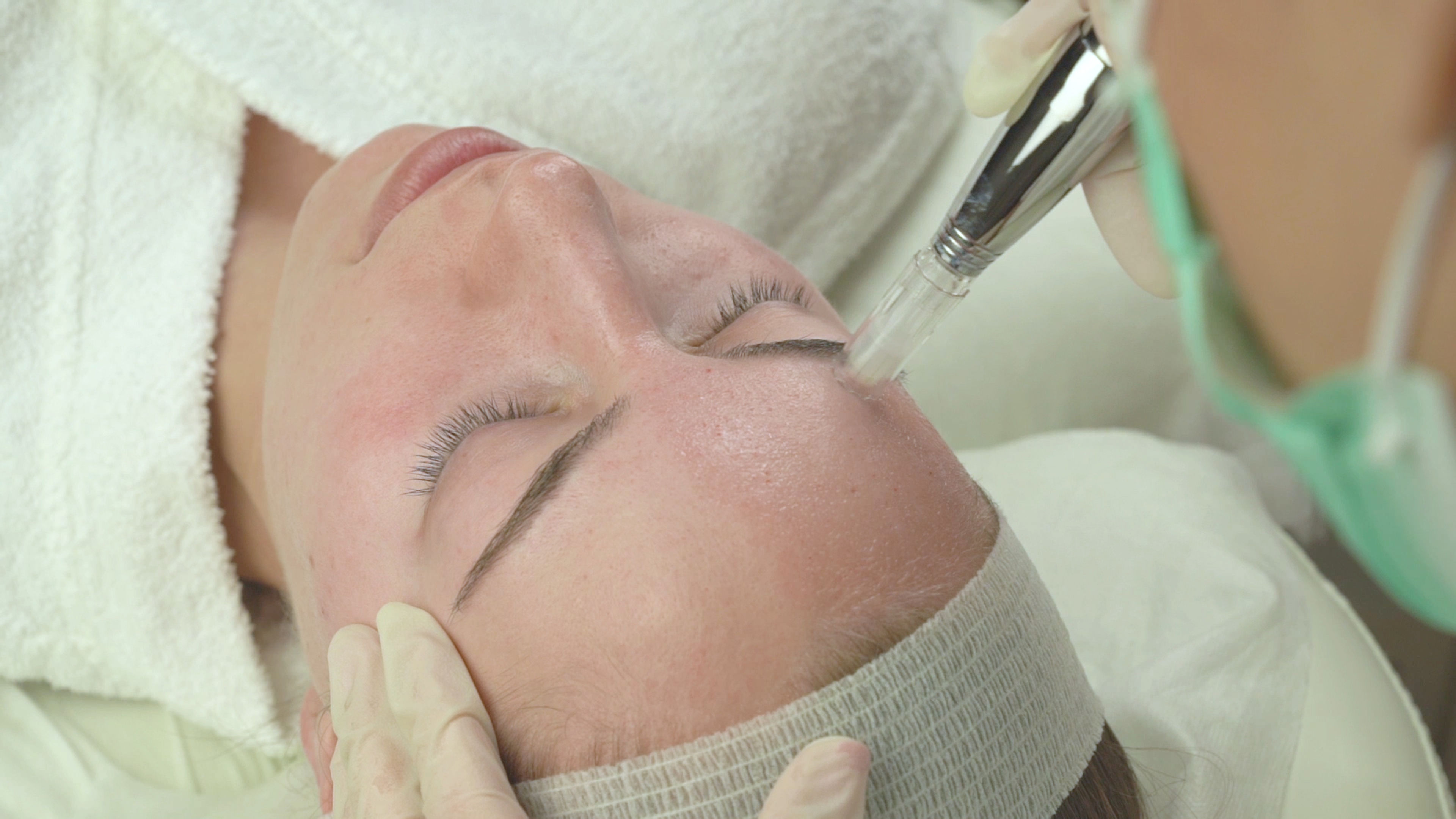 MICRO NEEDLING